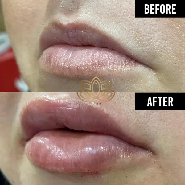 Aumento de Labios con Ácido Hialurónico