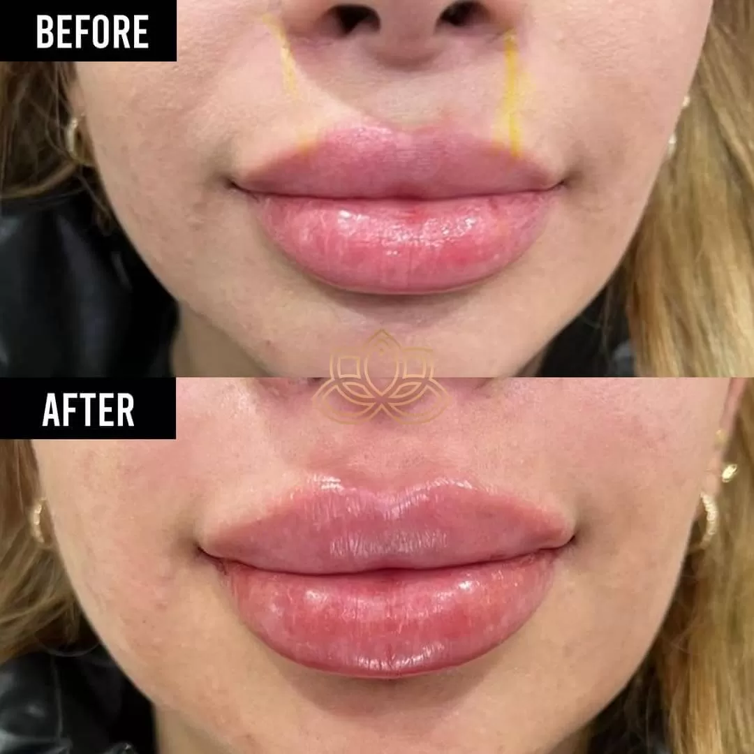 Lip Augmentation