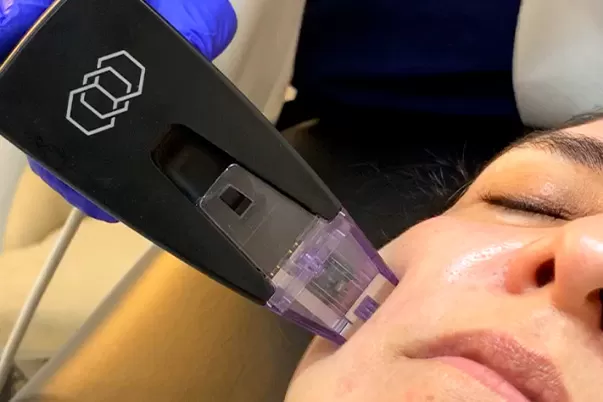 Morpheus Burst treatment at Vive Med Spa Tijuana