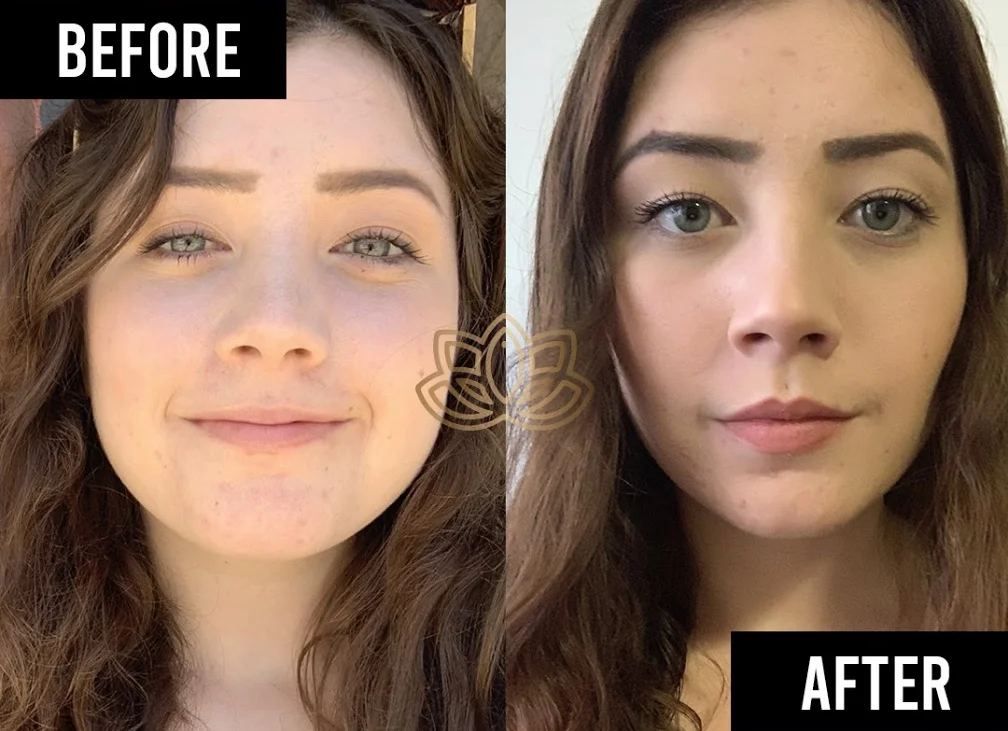 Antes y después de eliminación de grasa bucal - Vive Medical Spa Tijuana