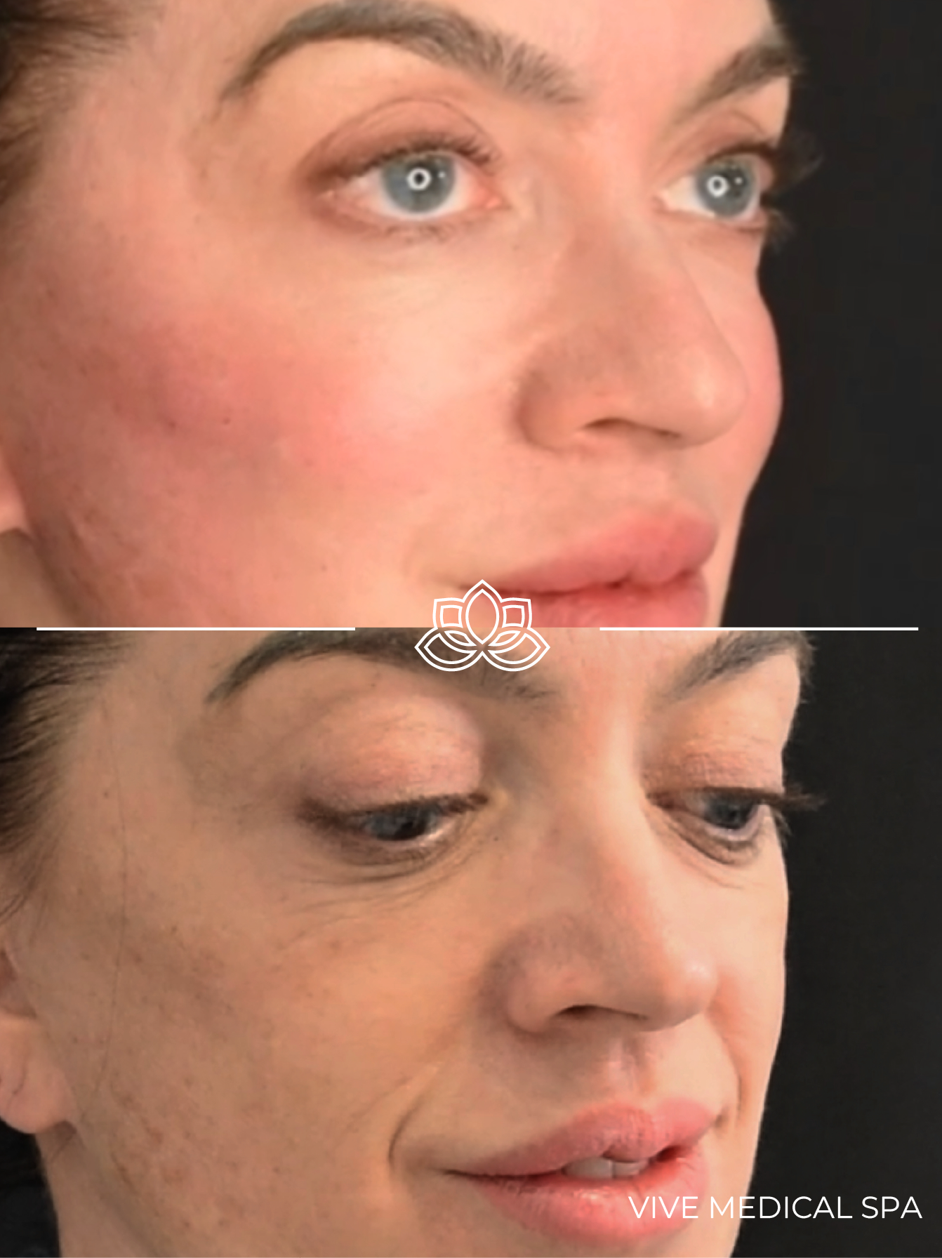 Cheek Fillers at Vive Medical Spa Tijuana