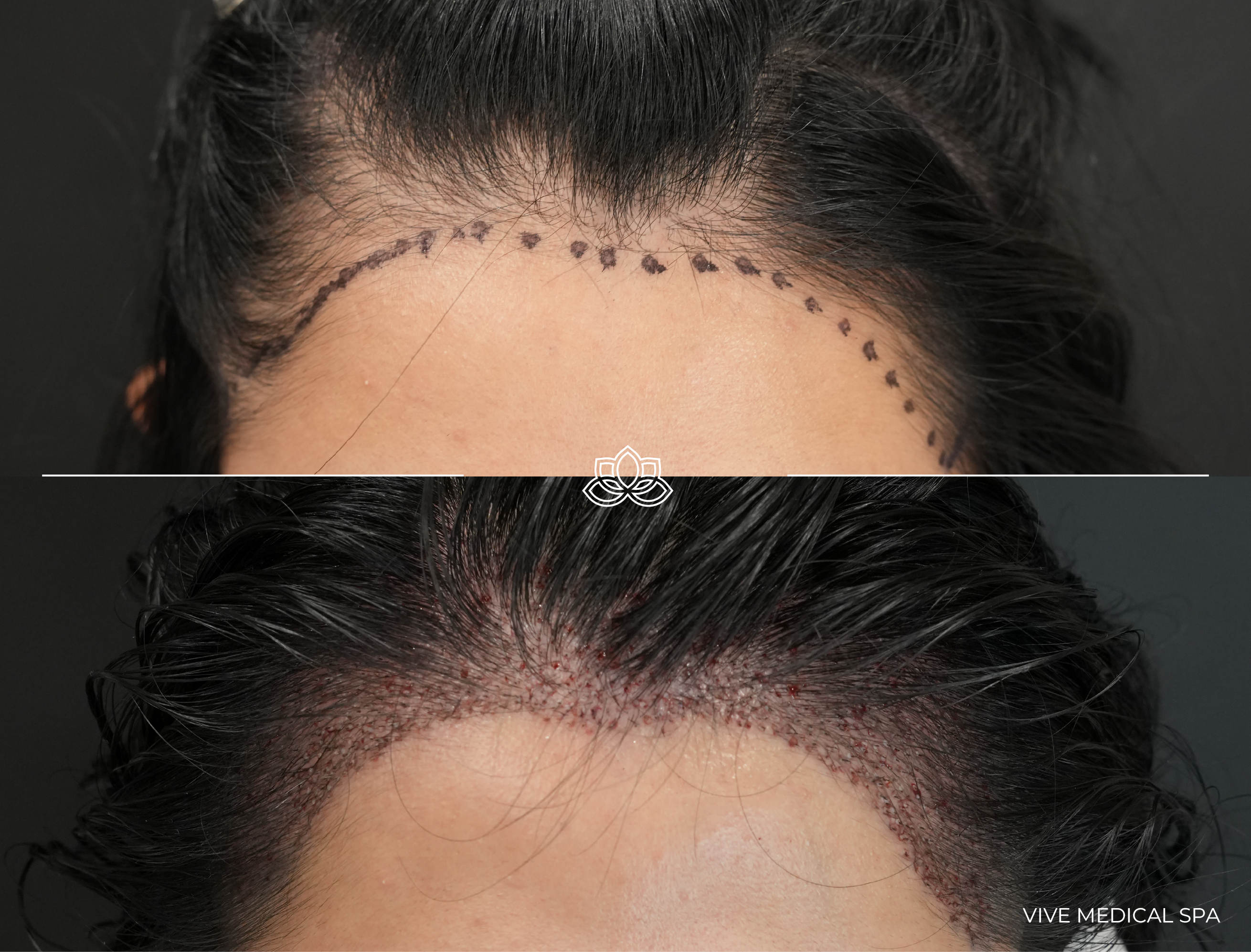 Trasplante Capilar FUE en Tijuana - Resultados de apariencia natural en Vive Med Spa