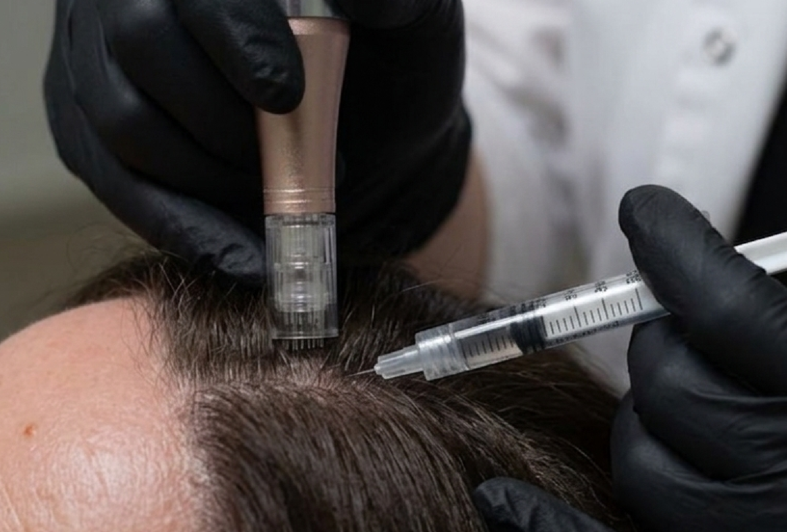 Consulta de mesoterapia capilar en Vive Med Spa