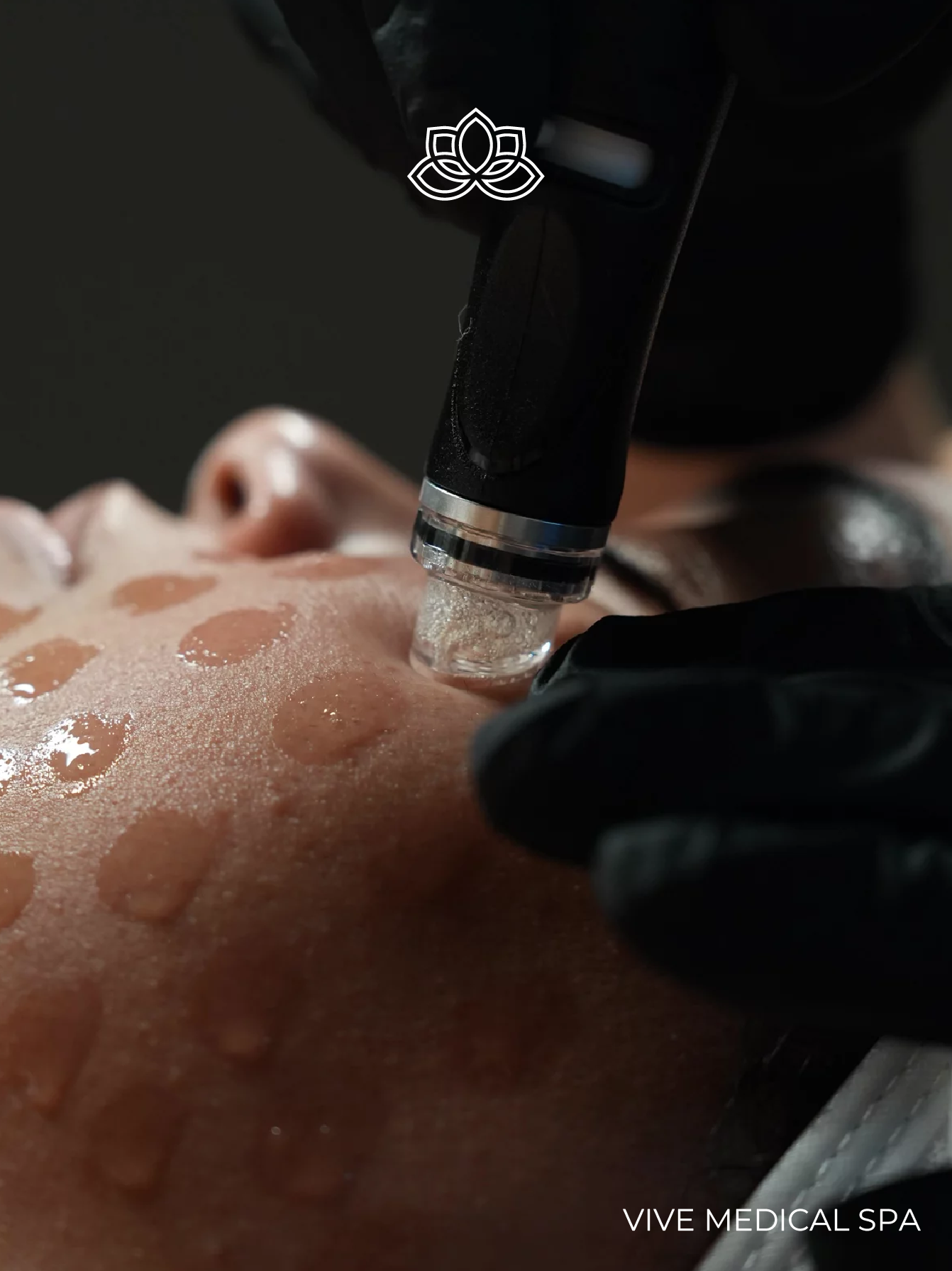 Tratamiento de Hydrafacial en Vive Med Spa Tijuana