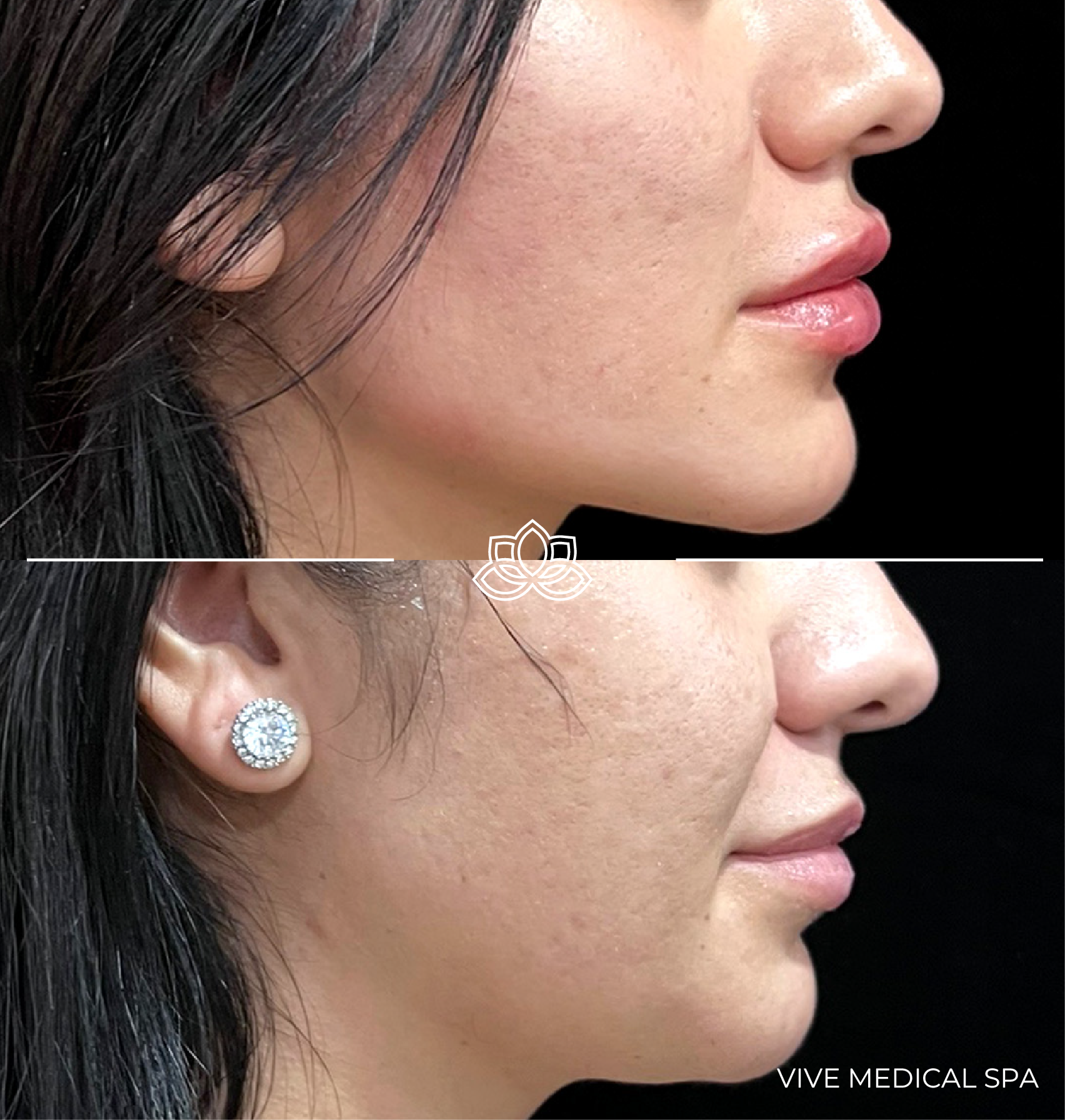 Resultados de contorno mandibular - Vive Medical Spa
