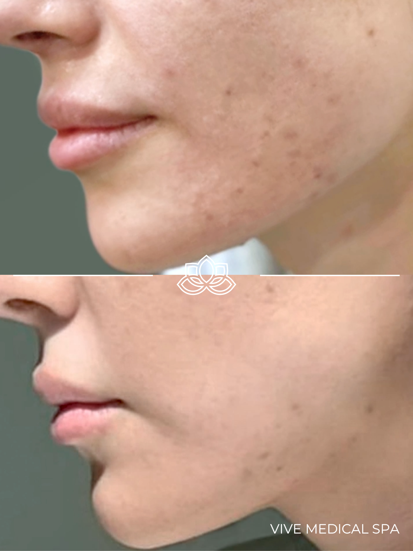 Tratamiento con Kybella en Vive Medical Spa: reducción de papada
