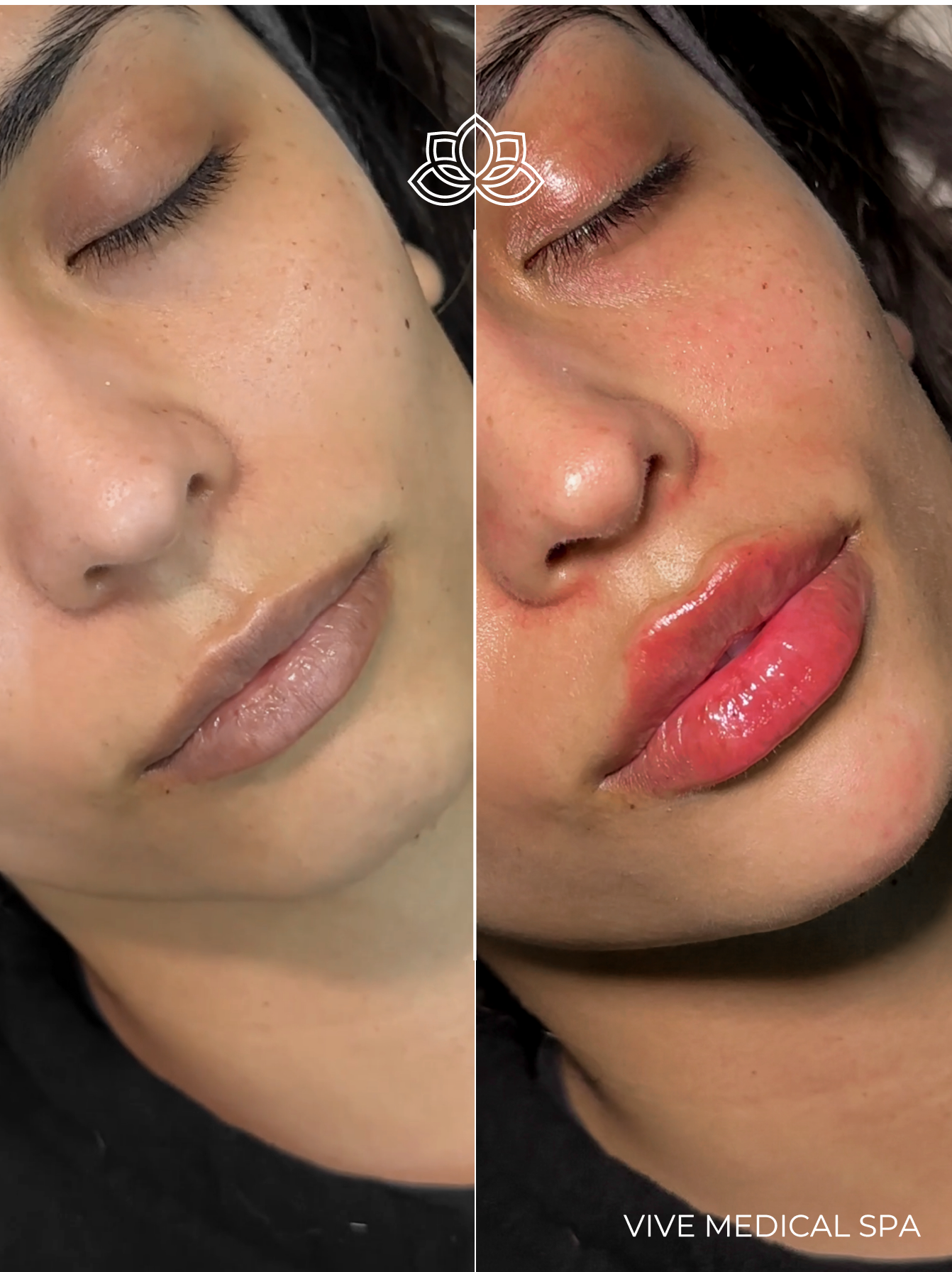 Resultados de relleno de labios en Vive Spa Médico Tijuana - mejora de apariencia natural