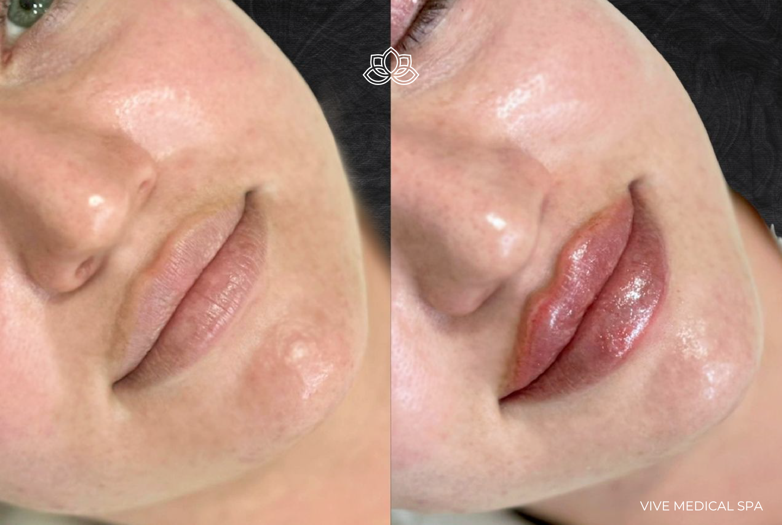 Aumento de labios - Resultados - Vive Spa Médico Tijuana