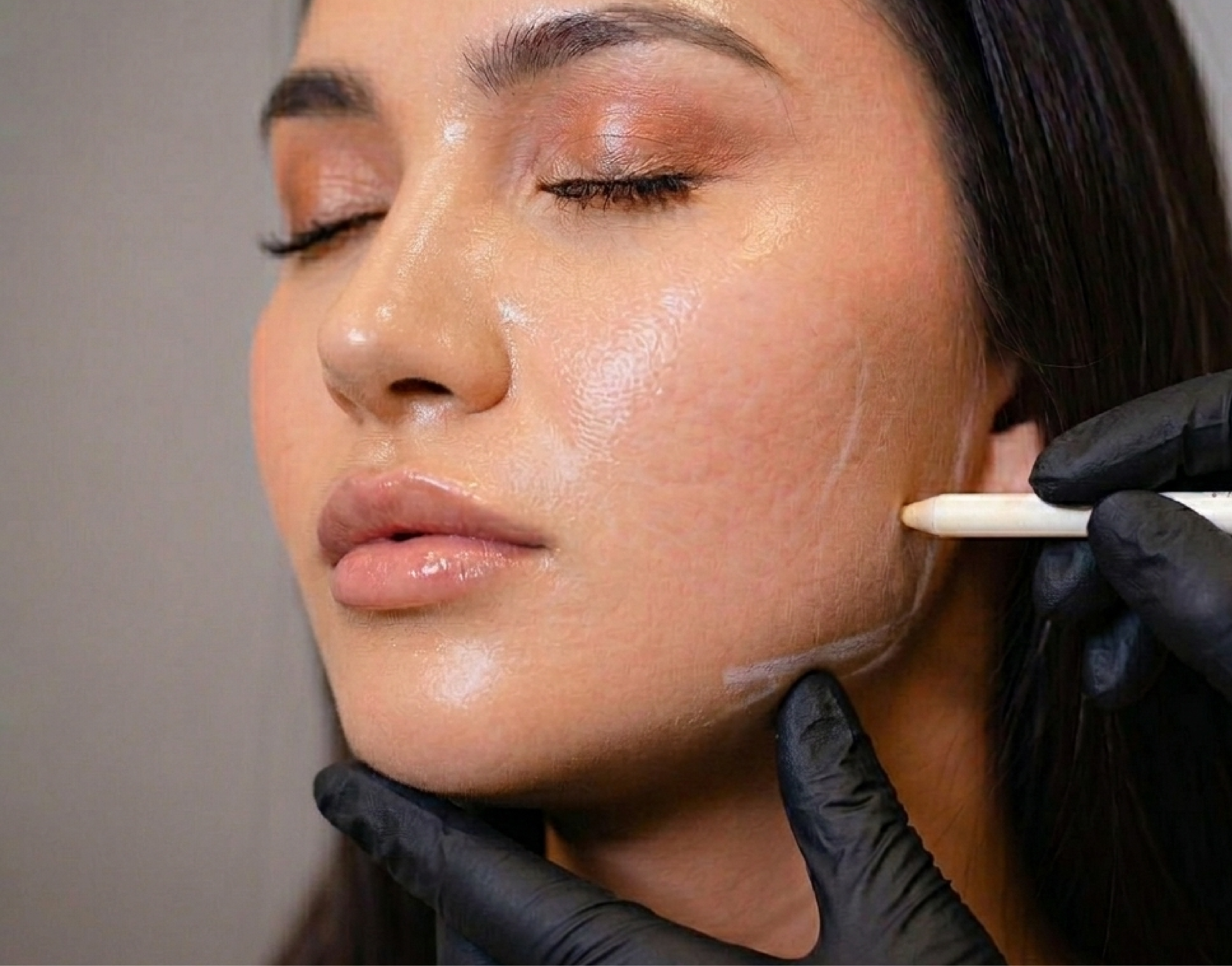Bioestimulación Facial