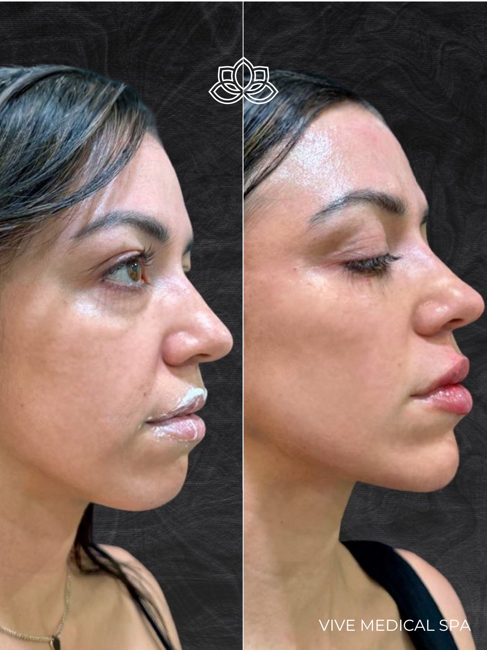Tratamiento inyectable con Sculptra: estimulación de colágeno con ácido poli-L-láctico