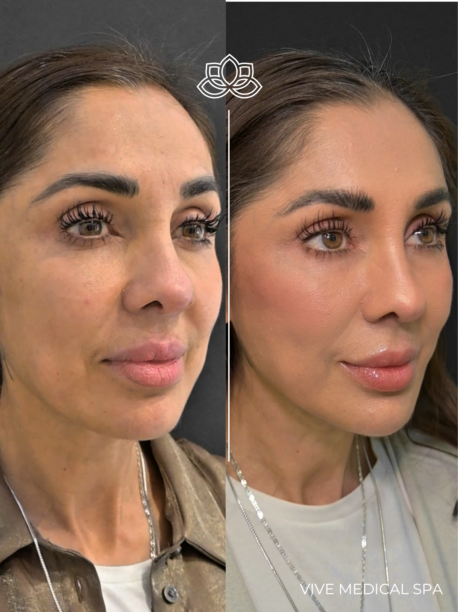 Lifting facial por ultrasonido Ultraformer MPT en Vive Med Spa Tijuana, México - lifting no quirúrgico